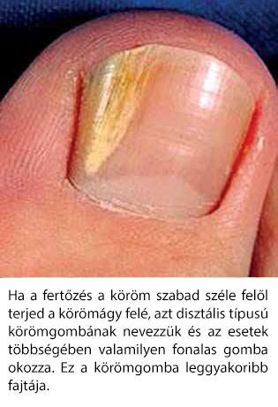 nail gombák ok kezelés)
