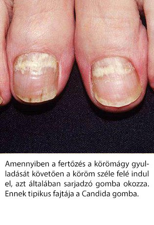 canison gomba elleni köröm kezelés gomba nail urotropin